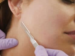 Dermaplaning