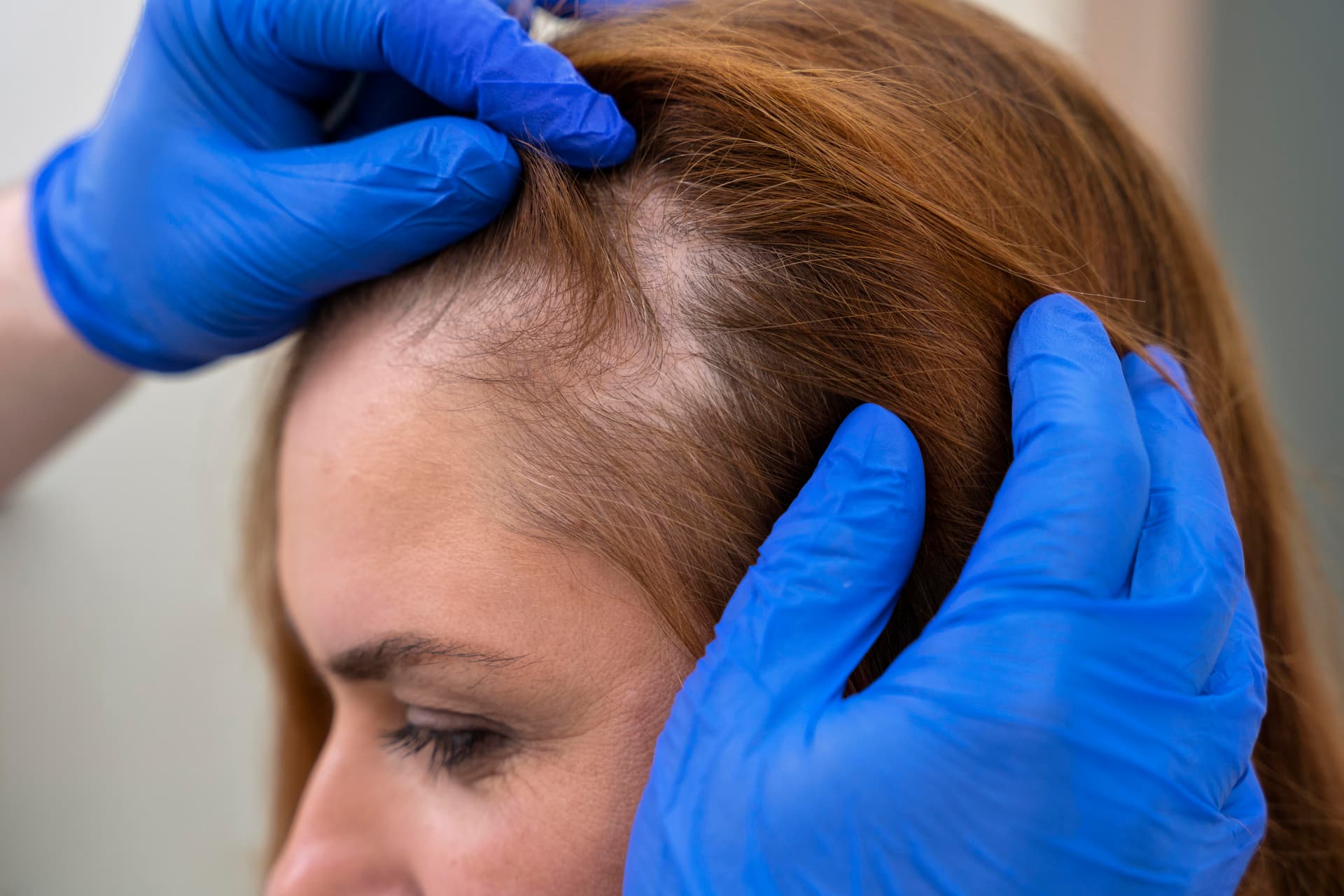 PRP Hair Loss